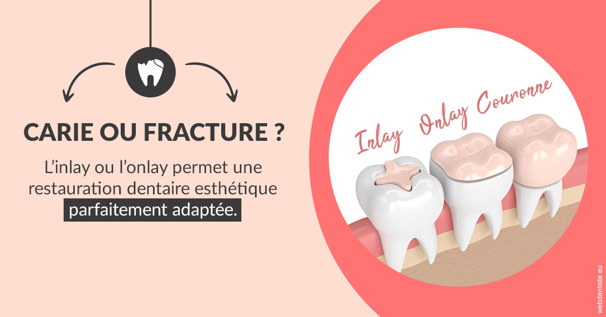 https://dr-asquinazi-ml.chirurgiens-dentistes.fr/T2 2023 - Carie ou fracture 2