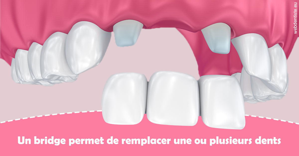 https://dr-asquinazi-ml.chirurgiens-dentistes.fr/Bridge remplacer dents 2