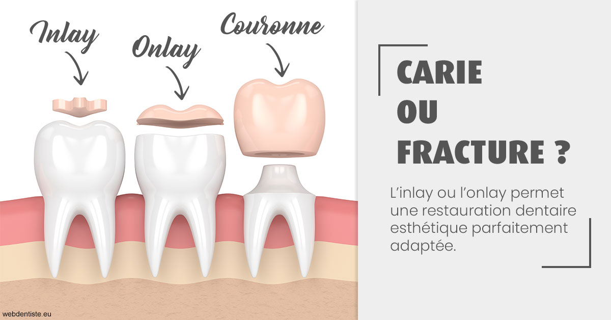 https://dr-asquinazi-ml.chirurgiens-dentistes.fr/T2 2023 - Carie ou fracture 1