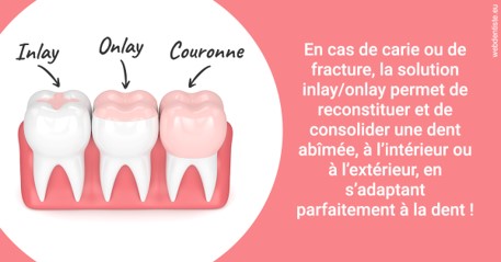https://dr-asquinazi-ml.chirurgiens-dentistes.fr/L'INLAY ou l'ONLAY 2